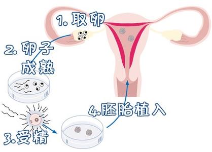 助孕借卵试管机构
